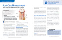 Root Canal Retreatment - Dear Doctor Magazine